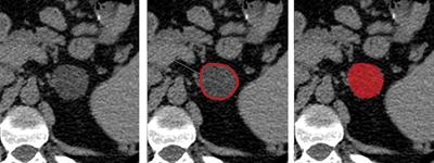 Machine Learning-Based Texture Analysis in the Characterization of Cortisol Secreting vs. Non-Secreting Adrenocortical Incidentalomas in CT Scan